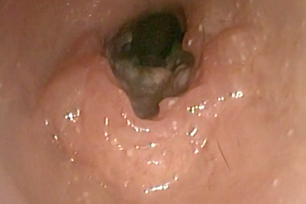 Carcinoma del colon nel gatto